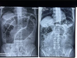colonoscopic deflation or decompression of sigmoid volvulus,dr masfique