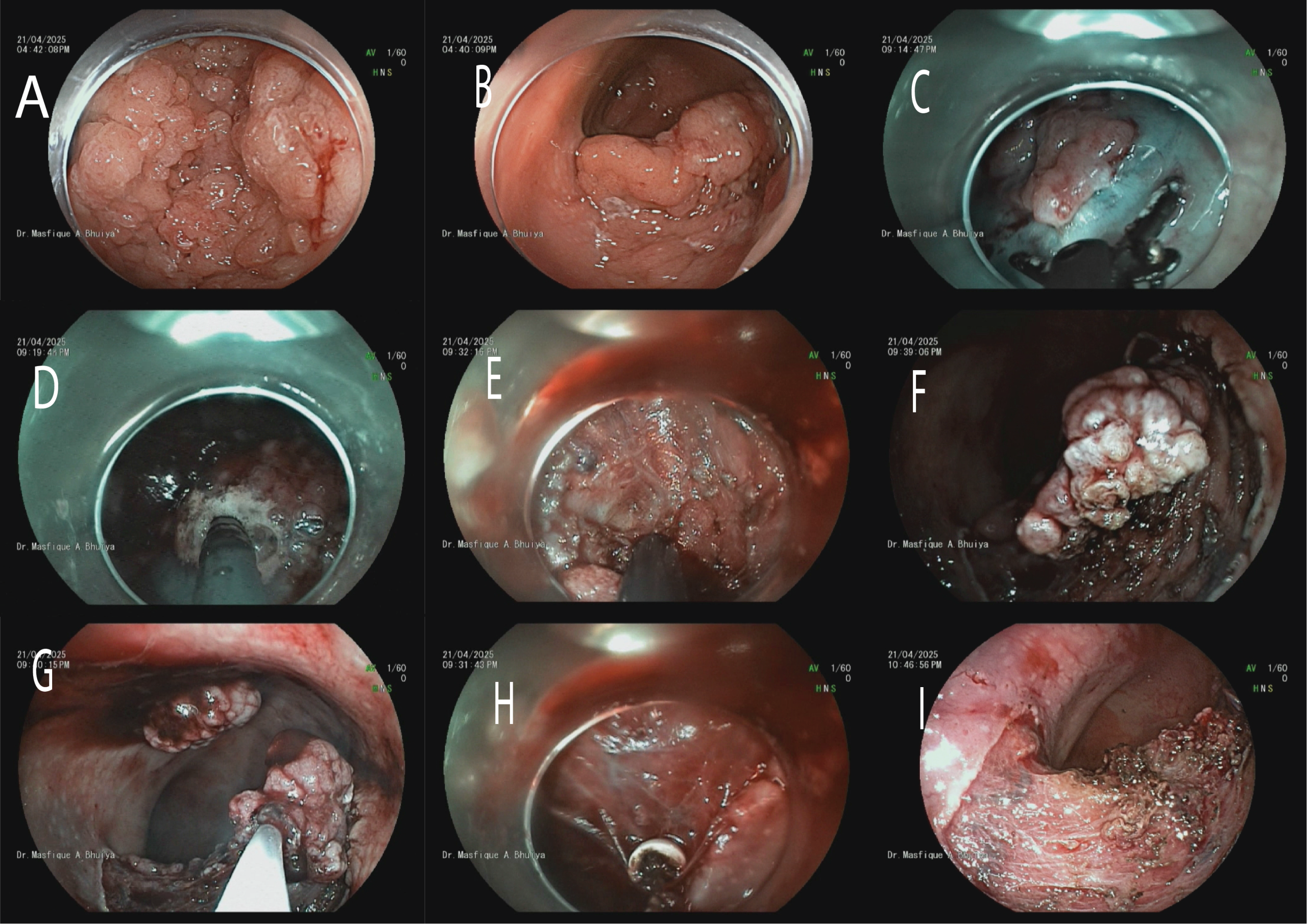 একজন মহিলা রোগীর Colon Growth অপারেশন ESD পদ্ধতিতে সফলভাবে সম্পন্ন