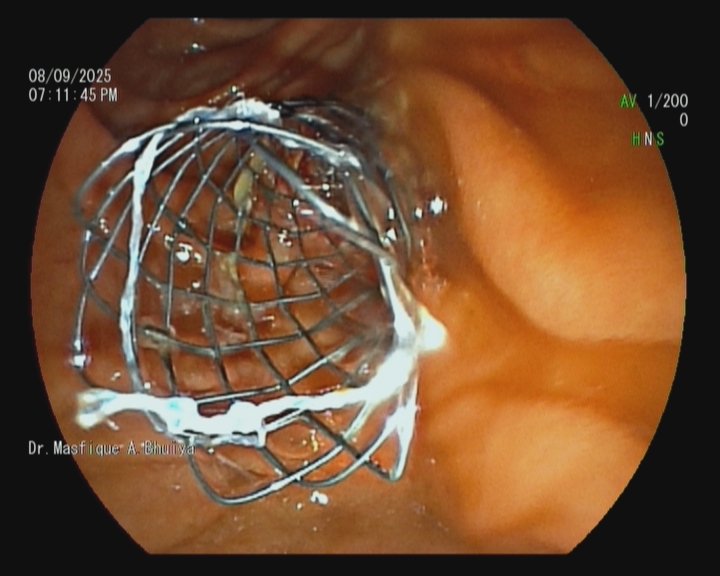ERCP SEMS Deployment in Klatskin (Cholangiocarcinoma) Tumour. BD ERCP Center